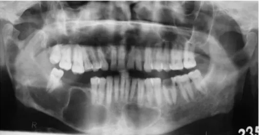 Fig. 2. Panoramic radiograph shows multiple unilocular radiolucencies in mandibular body, ramus, and  sym-physis region and a smaller  uniloc-ular radiolucency in the right  maxil-lary tuberosity area.