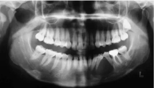 Fig. 2. Panoramic radiograph shows a well-defined unilocular  radioluc-ency in the left mandibular body region.