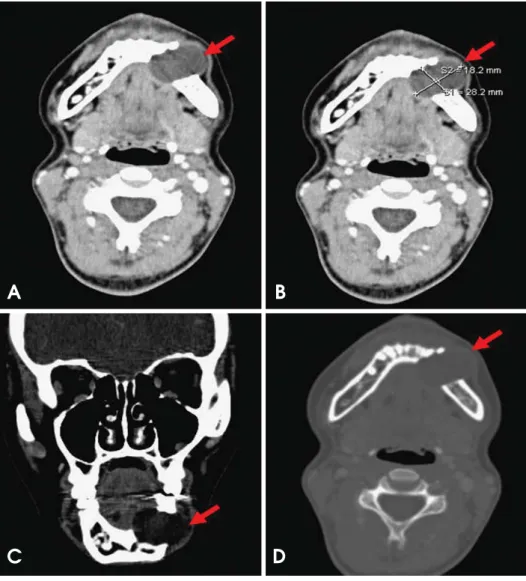 Fig. 3. Computerize tomography (CT) images. A. The axial CT scan (soft tissue window with contrast) shows a low density lesion that caused expansion and destruction buccally and lingually