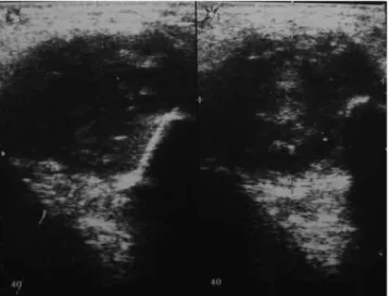 Fig. 5. Histopathologic examination shows a parakeratinized epithe- epithe-lium with a clear basal layer and a wavy appeared luminal surface.