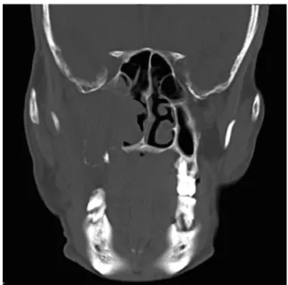 Fig. 3. Coronal CT image shows a large soft tissue density lesion with destruction of all walls of the right maxillary sinus, hard  pal-ate, and extension into the nasal cavity.