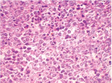 Fig. 6. Histopathological examination shows connective tissue stroma made up of predominantly large lymphocytes, few small cells, and scattered foamy macrophages (H&amp;E stain, ×400)