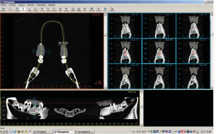 Fig. 2. Implant planning procedure using V-Implant software.