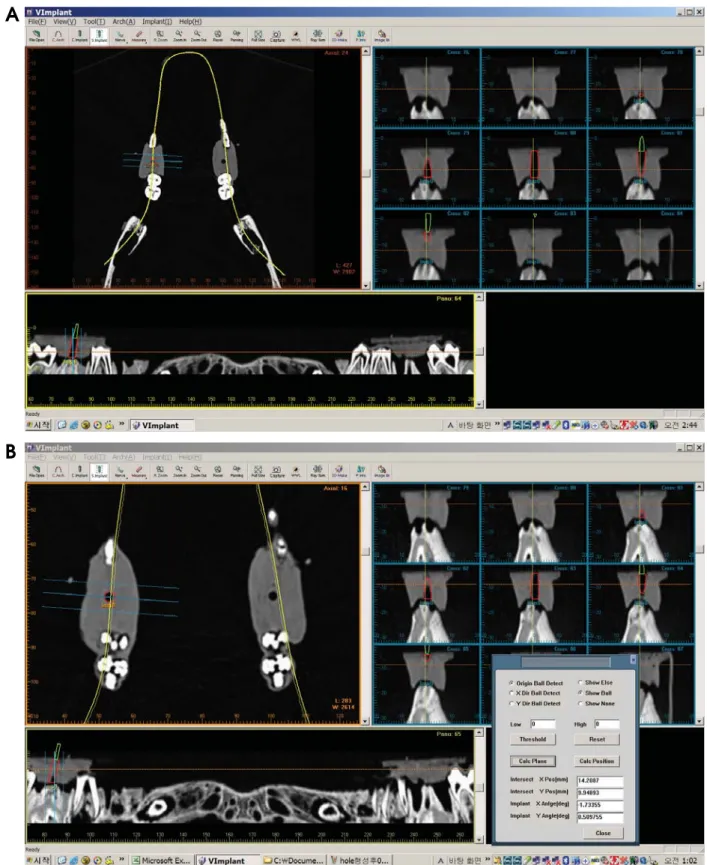 Fig. 7. A. The guide hole is shown as the black cylindrical area on the CT image. The virtual implant is placed into the guide hole on the software