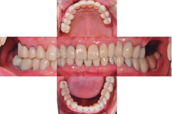 Fig. 3.  구강형성 및 임시치아 장착 사진