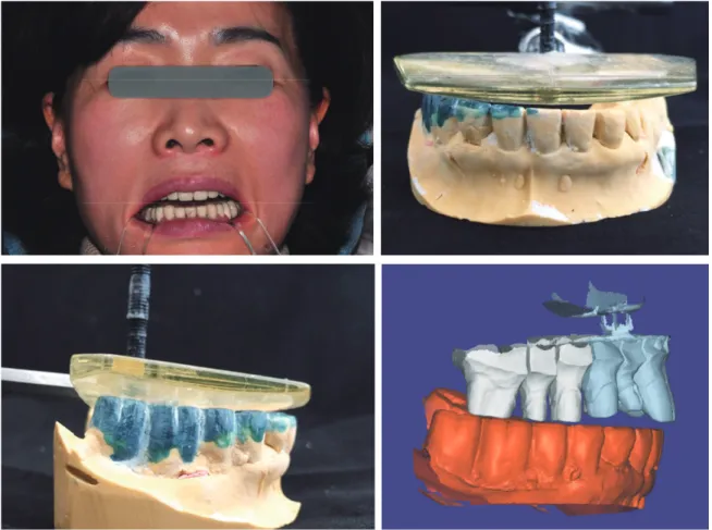 Fig. 4.  1개월 증대된 교합고경에 적응 후 평가 결과 임시치아의 수평선이 동공간선과 차이가 있어서 2차 임시치아 제작. 