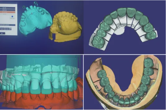 Fig. 12.  적응된 임시치아를 최종 수복물 디자인에 옮기는 과정. 지대치 모형과 임시수복물 모형 을 이중스캔한 후 이를 정합하였으며, 최종 수복물의 디자인을 임시수복물 실루엣에 맞추는 명령어 를 내린 다음 마진부와 접촉부의 미세조정으로 임시치아의 형태를 그대로 복제하였으며, 전방 및 측 방유도에 따른 상악 설측 형태 또한 복제가 되었다.