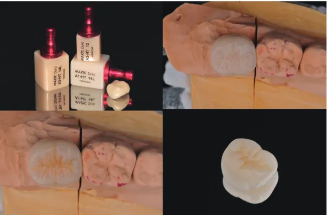 Fig. 7-1.  Clinical CaseⅠ(The Whole Process of Making Crown #37)