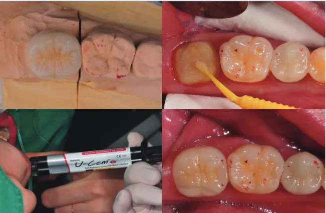 Fig. 7-3.  Clinical CaseⅠ(The Whole Process of Making Crown #37)