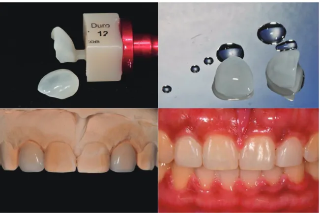 Fig. 12.  Making Clinical Case(Veneers)