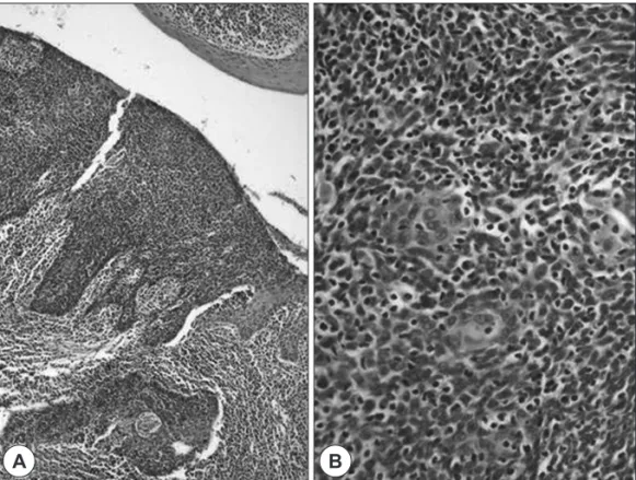 Fig. 2. Pathologic finding shows that the tumor is composed of invasive nests of basaloid cell(A)(H-E stain, ×40) and basaloid cells that  form compact nest, peripheral cells show palisading pattern(B)(H-E stain, ×400)