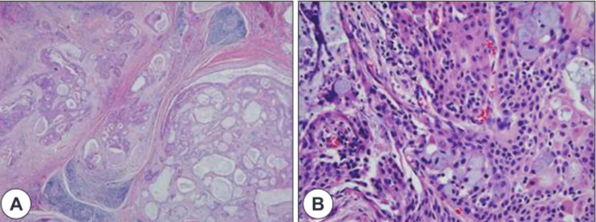 Fig. 3. Histopathologic findings. A : There are above 25% of intracystic component and no evidence of pleomorphic adenoma(H &amp; 