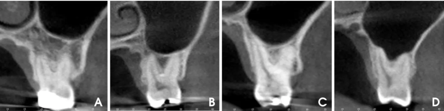 Fig. 1. CBCT images show 4 types of vertical relationships between the root of the maxillary molars and the sinus floor