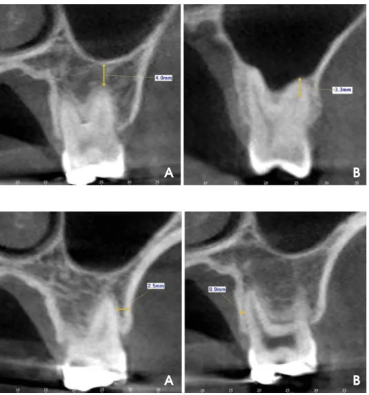 Fig. 3. The distance between the root apex and the sinus floor is  mea-sured using CBCT cross-sectional images
