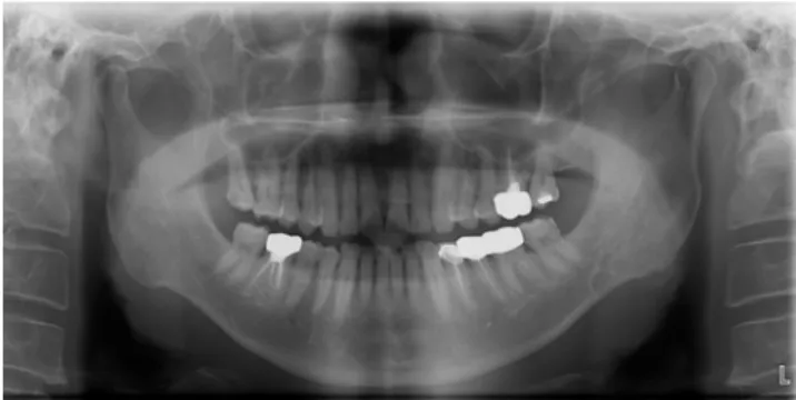 Fig. 1. Panoramic radiograph reveals a well-defined multilocular radiolucent area beneath the mandibular canal at the root of the second molar tooth.