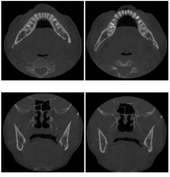 Fig. 2. Axial CBCT images show a lingual bony defect located at the lingual side of the mandibular canal.