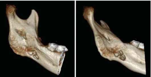 Fig. 5. Three-dimensional CBCT images reveal a bony defect  extend-ing from the medial surface of the mandible.