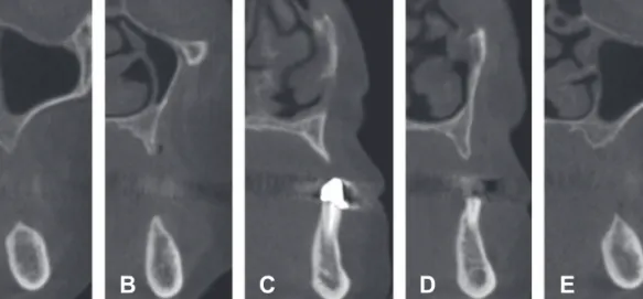 Fig.  4.  Preoperative cross-sectional views of mandibular arch. A. First molar area on right side; B