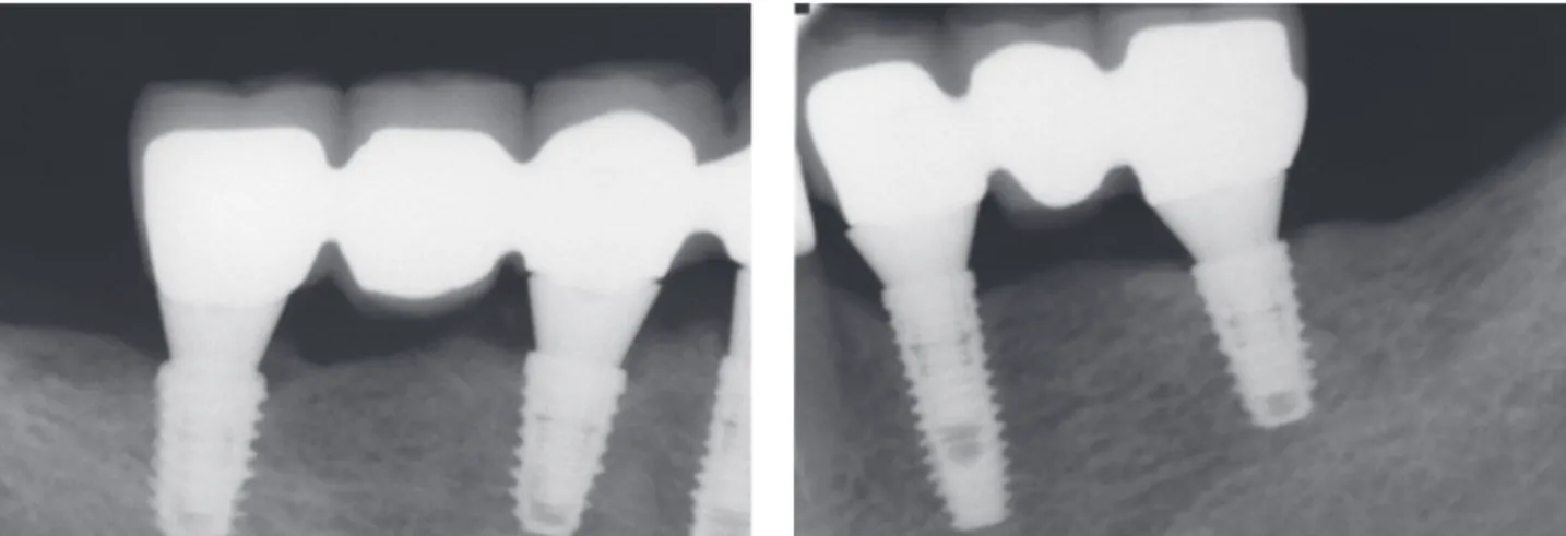 Fig. 10.  Intraoral periapical radiographics at the 1-year follow-up after loading.