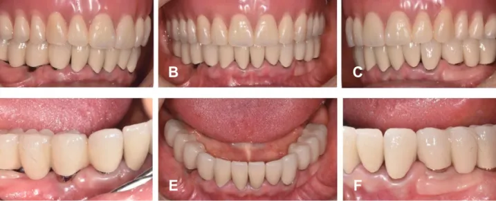 Fig. 12.  Panoramic radiographic at the 4-year follow-up after loading.