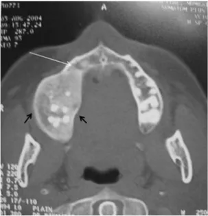 Table 4.  CT findings showing radiographic features