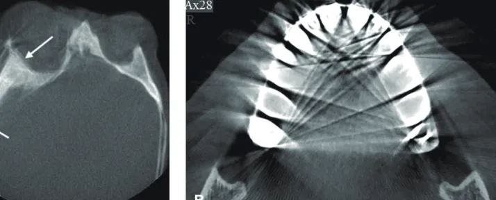 Fig. 6.  (A) significant motion artifact (B) significant metal artifact