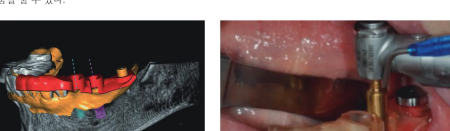Fig. 8.  (A) 가이드 디자인 프로그램 상에서 SAM 마커를 기준으로 이용하여 정합한 모습 (B) 가이드 고정시에 SAM 마커에 상부구조 를 연결하여 고정하여 수술하는 모습