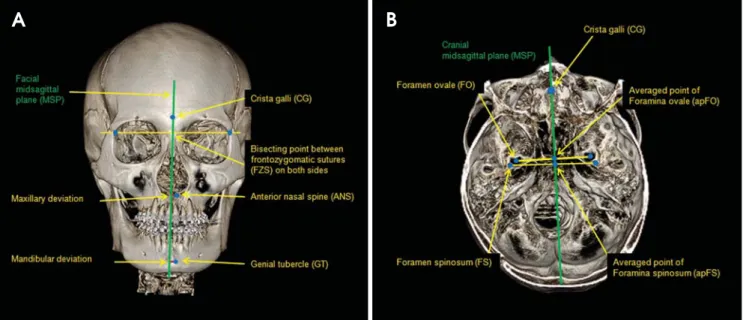 Table 1 and Fig. 1 show the definitions of the landmarks used. Crista galli (CG) was used as the common reference point of the face and cranium for MSP (Fig