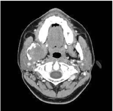 Fig. 6. Coronal CT image shows massive bone resorption of the right mandibular condylar process and ramus.