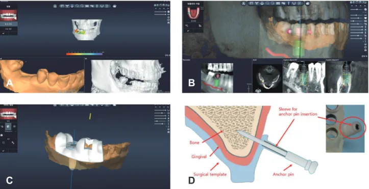 Fig. 17.  Dentiq guide(Dentis) 소프트웨어를 이용하여 (A) 스캔데이터와 CT데이터를 정합 (B) 임플란트 위치 선정 (C) 드릴링 키트와  호환되도록 가이드 디자인 (D) 치아지지가 아닌 연조직지지 완전무치악의 경우 필요한 별도의 고정 anchor 모식도