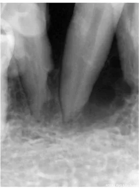 Fig. 3. Panoramic radiograph shows a radiolucent area measuring 4×4 cm in diameter extending from the distal aspect of the right lateral incisor to the mesial aspect of the second premolar.