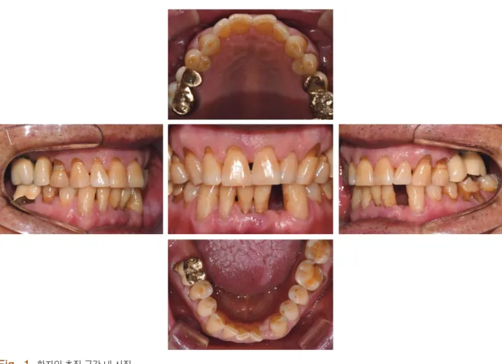 Fig. 1.  환자의 초진 구강 내 사진