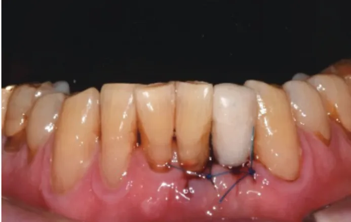 Fig. 9.  임플란트 식립 3개월 뒤 환자의 구강내사진