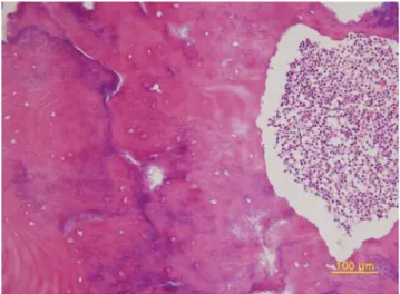 Fig. 4. Saucerization and decortication are performed on that area with sequestrectomy.