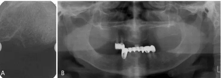 Fig. 8. A. Axial CT image reveals separated lamina dura on socket of left maxillary canine