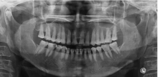 Fig. 1. Panoramic radiograph shows the impacted tooth in the right  mandi-bular condylar head