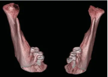 Fig. 5. Frontal view of 3-dimensional volumetric CBCT image shows the crown of the impacted tooth partially covered with bone.