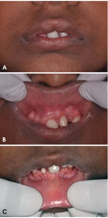 Fig. 1. A. The patient has bilateral post axial polydactyly of both hands. B. The patient cannot make tight fist