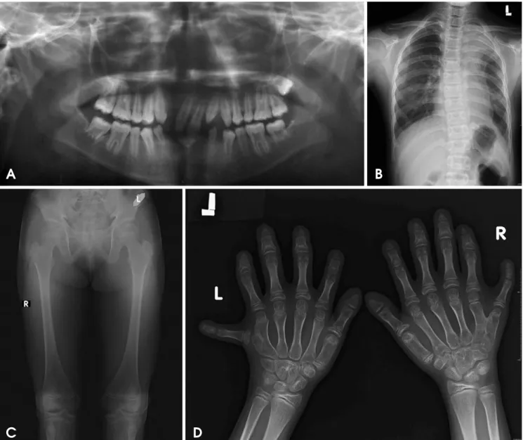 Fig. 3. A. Panoramic radiograph shows conical shaped teeth, missing mandibular permanent anterior, retained deciduous mandibular canine and right lateral incisor