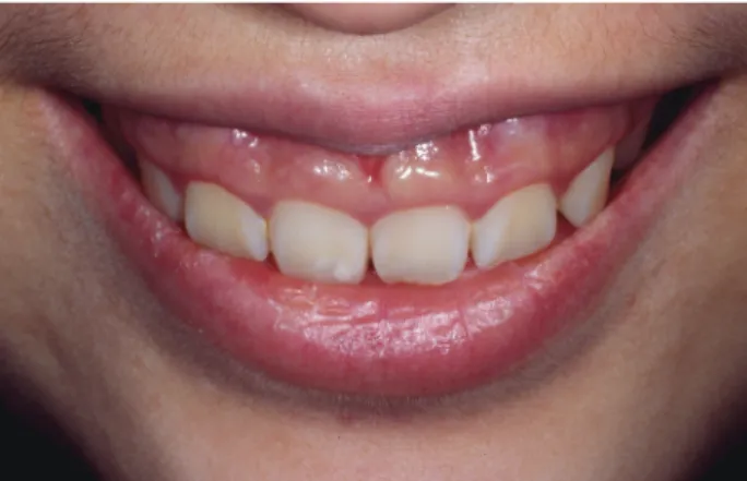 Fig 2-1.  웃을때 심한 gummy smile양상을 보인다.
