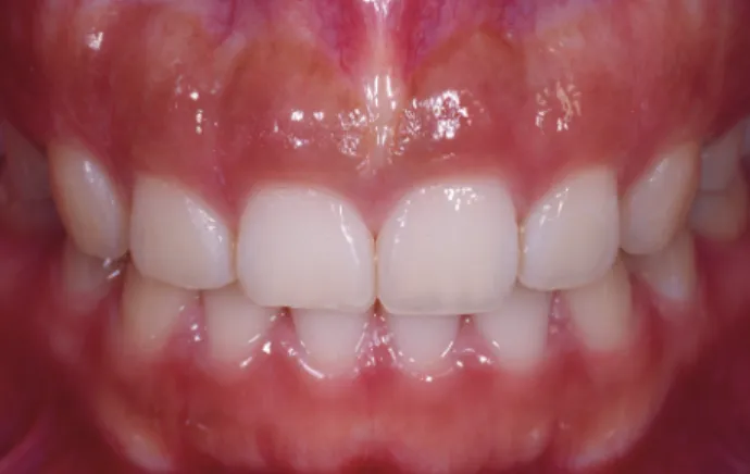 Fig  1-2.   교정치료후  gingivectomy  를  한  차례  시행했지만  rebound되어서 의뢰됨. Gingiva가 치아의 crown portion을 과도 하게 덮고 있다.