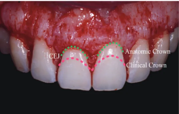 Fig 1-4.를 다시 보자. Clinical crown이라고 되어 있는 곳까지  marginal gingiva가 위치되어져 있었고, Anatomic  crown이라고 되어 있는 곳이 CEJ이다