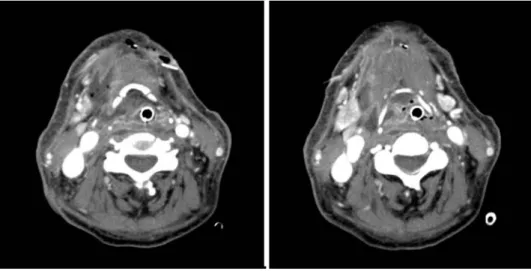 Fig. 4. Contrast-enhanced CT ima- ima-ges at two days after first operation show the increased extent of right submandibular abscess to  preverte-bral space and posterior to the right sternocleidomastoid muscle, and cellulitis and myositis of left  sub-men