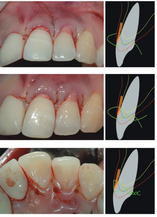 Fig 24-4.  설측에 knot를 만들어 준다.