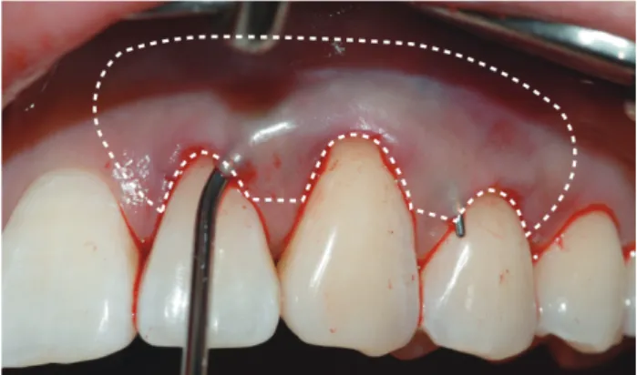 Fig 2.  Modified Langer &amp; Langer technique. 수직절개는 없고, 수평절개만 있다.
