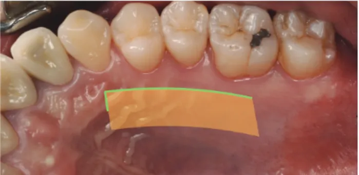 Fig 7.  Single incision technique - 블레이드의 접근 방향의 제 약으로 인해 근심과 원심의 끝에서 수직절개를 줄 때 비스듬한 방 향으로 이루어지기 쉽다