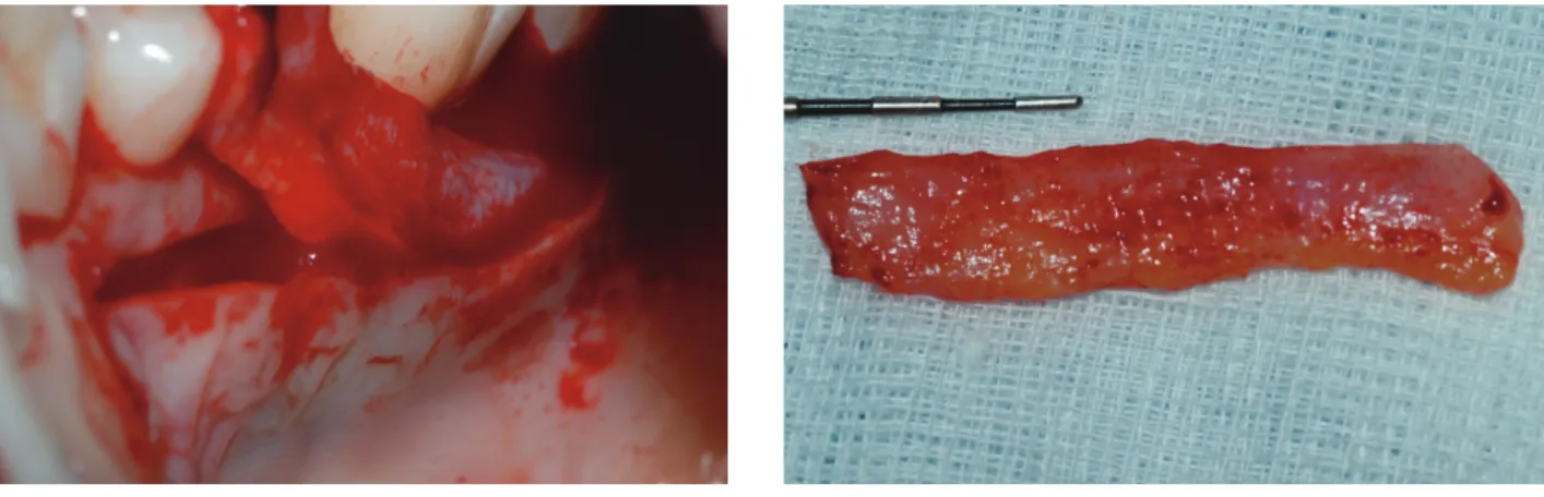 Fig 10.  Single incision technique (하나의 수평절개)