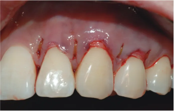 Fig 19 . 결합조직이 이식될 위치를 보여준다. Fig 21.  술후 1주 Fig  20.  결합조직이 이식된 후 최종적인 봉합이 완성된 모습 (tunnel technique)Fig 22