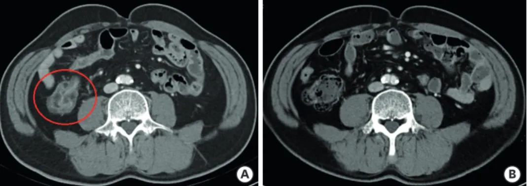 Figure 1. Enterocolitis related to immune checkpoint inhibitors. (A) Before steroid treatment, axial contrast  computed tomography scan shows wall thickening and abnormal enhancement in intestine