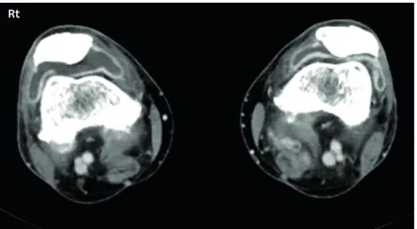 Figure 2. Inflammatory arthritis related to immune checkpoint inhibitors on both knees; axial contrast computed  tomography scan show moderate joint effusion of both knees (right &gt; left) with associated synovial thickening.